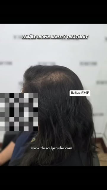 Restoring crown density for female pattern hair loss!

For women experiencing female pattern hair lo