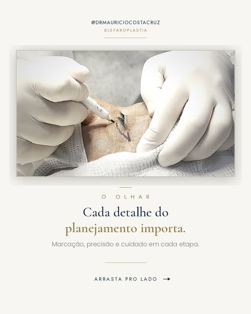 O olhar carrega o cansaço antes de qualquer outra coisa no rosto. 👁️

Na blefaroplastia, cada detal
