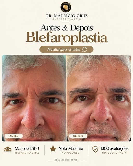 Na blefaroplastia, cada detalhe do planejamento importa. Durante a marcação pré-operatória, identifi