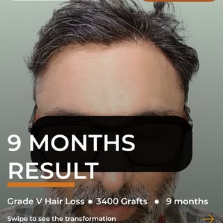 A natural-looking transformation begins with careful planning.
This is a real patient result after 3
