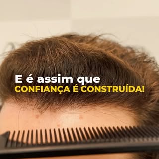 ✔️ Paciente jovem com calvície extensa! O Resultado parcial após 6 meses da cirurgia já mostra uma e