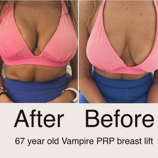Vampire PRP Breast lift has many benefits, it increases elastin (a protein that allows tissue to str