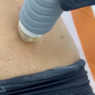 Vivace Microneedling for Abdominal Tightening: A Modern Approach to Body Contouring