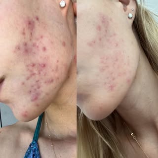 After 3 sessions of Aerolase treatment.  #acne #skincare #beauty #skin #skincareroutine #antiaging #