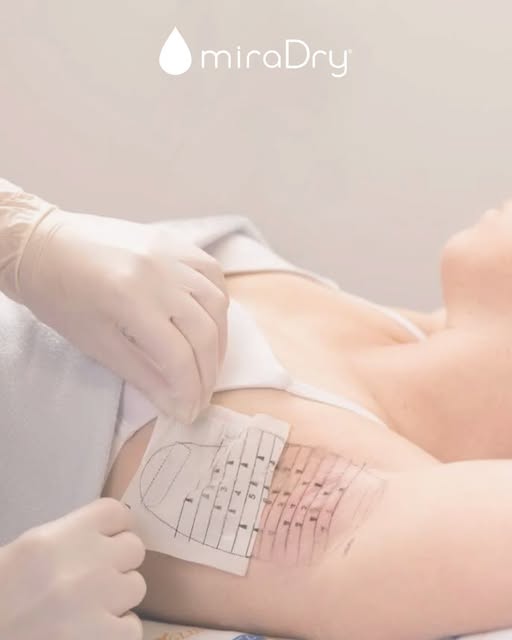 miraDry works by delivering energy to the sweat and odor glands, stopping them from producing moistu