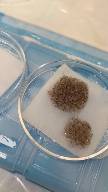 Hair Transplant Grafts:⁠
⁠
After harvesting the grafts from the patients scalp. They are grouped in 