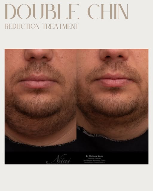 At Nitai Medical & Cosmetic Centre we offer consultations to reduce double chin in which our doctor 