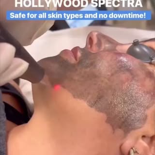 WHAT IS A HOLLYWOOD LASER PEEL?

The Hollywood Laser Peel® is a painless, no-downtime, highly reques