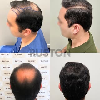 One session

👉 calvície extensa: área de tratamento frente, meio e coroa
👉 discreto rebaixamento d