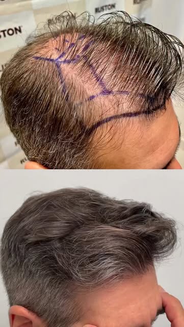 Como exibir Resultados na Internet:

👉 mostrando o HAIRLINE em CLOSE UP
👉 VIDEOS  com os cabelos s