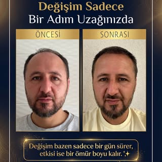 Değişim sadece bir adım uzağınızda! 💈

Başarılı bir saç ekimi operasyonu ile yılları geri sarmak mü