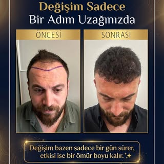 Değişim sadece bir adım uzağınızda! 💈

Başarılı bir saç ekimi operasyonu ile yılları geri sarmak mü