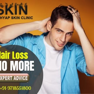 Hair loss has always been a major concern for men & women both. Treating Hair Loss has been a challe