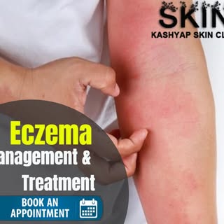 Eczema - There is no permanent cure for eczema. However, a proper skin care treatment can often cont