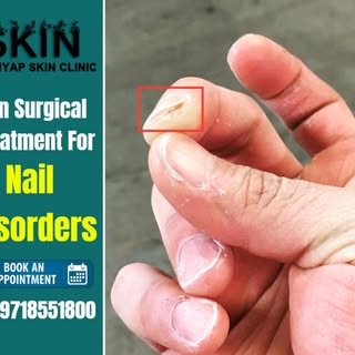 Ingrowing Toe Nails, Fungal infections, Nail discoloration, Paronychia Infection are the common Nail