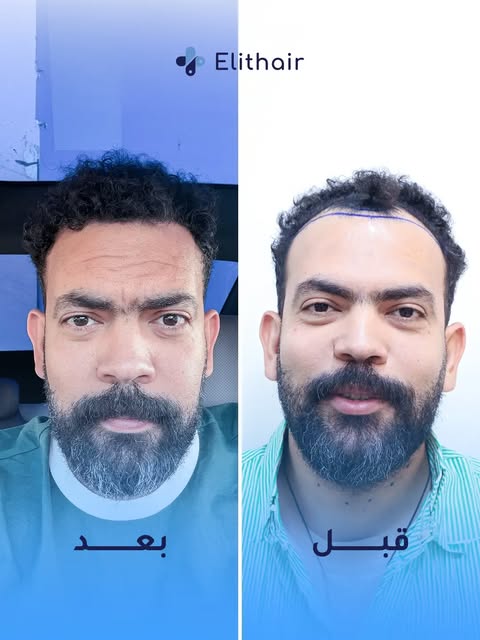نتيجة زراعة الشعر للمذيع خالد عليش بعد 8 شهور فقط 
@khaledeleish

تم توزيع 5200 بصيلة على المنطقة ال