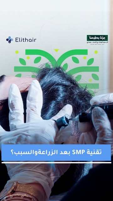 ⁨	ماهي تقنية SMP (اختصار لـ Scalp Micropigmentation) 
هي إجراء تجميلي غير جراحي يعتمد على صبغ فروة ا