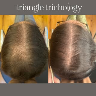 Autoimmune flare-ups can accelerate genetic hair loss (AGA), often without warning. Catching it earl