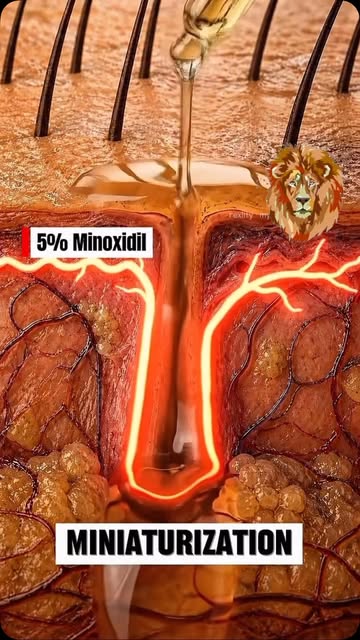 Uso de minoxidil requer disciplina e paciência na forma de loção …usar sempre duas vezes ao dia e nu