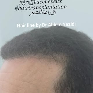 #greffecapillaire  #زراعةالشعر