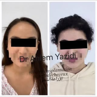 #greffedecheveux#greffecapillaire#hairtransplantation#زراعةالشعر