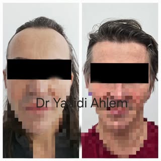 #greffedecheveux ##hairtransplantation 
#  زراعةالشعر