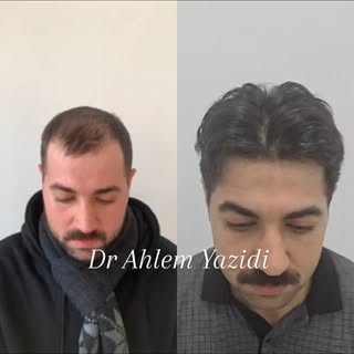 #greffecapillaire #greffedecheveux #hairtransplantation # زراعةالشعر