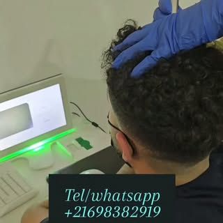#greffedecheveux #greffecapillaire #hairtransplantation #زراعةالشعر