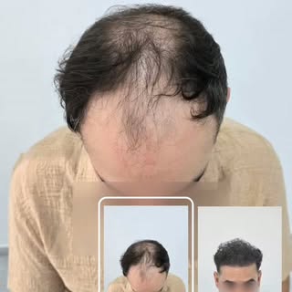 #greffedecheveux #زراعةالشعر #hairtransplantation