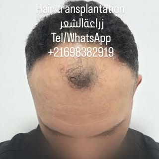 #greffedecheveux #زراعةالشعر #hairtransplantation