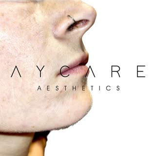 Lippenfiller mit natürlichem Ergebnis
.
.
.
#aesthetic #aesthetics #aycare #lippenunterspritzung #li