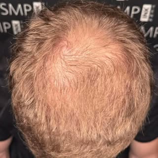 Check out this #beforeandafter a SMP density fill! Scalp micro-pigmentation is a great option for th