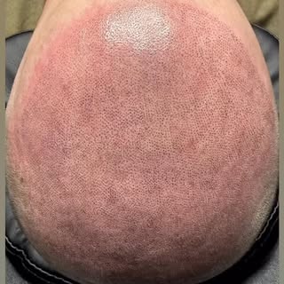 Trusting the process is key when it comes to Scalp Micropigmentation. This is the clients first sess