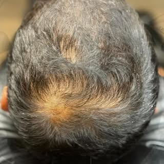 Before & After a density fill at SMP-INK/TENN
Regain your confidence with scalp micro-pigmentation, 