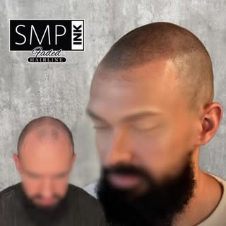 Before SMP & After the final perfection session.
Similar to a body tattoo, fresh SMP dots will fade 