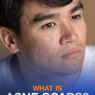 Acne is temporary… but what about the marks it leaves behind? 👀

Acne scars form when breakouts dam