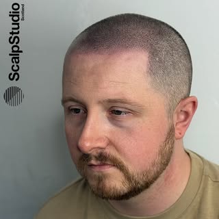 The art of getting the details right. 

scalpstudio.com

•

#scalpmicropigmentation #hairtransplant 