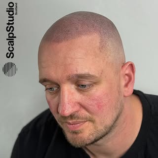 Designed to elevate a natural everyday look. 

•

#scalpmicropigmentation #hairtransplant #glasgow #