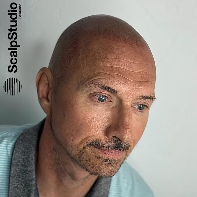 No guesswork. Just guaranteed results.

•

#scalpmicropigmentation #hairloss #hairtransplant #menshe