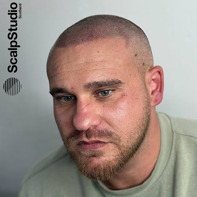 The perfect frame to your face 🤝

www.scalpstudio.com

•

#scalpmicropigmentation #hairtransplant #