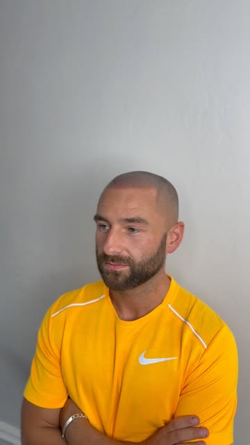 New hairline making an entrance 😮‍💨

•

#scalpmicropigmentation #hairtransformation #hairtransplan