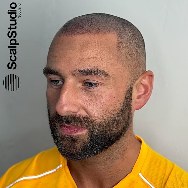 It’s all in the details. Meet your new hairline at Scalp Studio 🎯 

•

#scalpmicropigmentation #hai