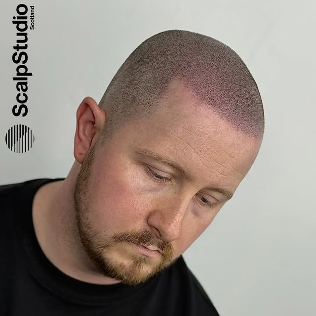 Your look starts with your hairline. 

scalpstudio.com 

#scalpmicropigmentation #hairtransplant #ha