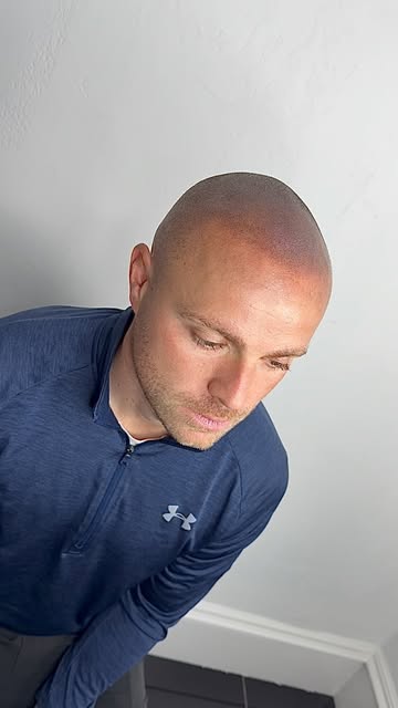 Natural Hairline. Seamless Result. 
Confidence Restored. 

•

#scalpmicropigmentation #hairtransplan