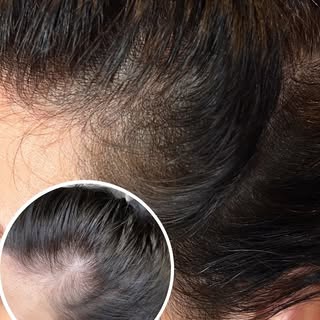 Use SMP to add natural looking density to hair!

#smp #scalpmicropigmentation #beautytips #hairloss 