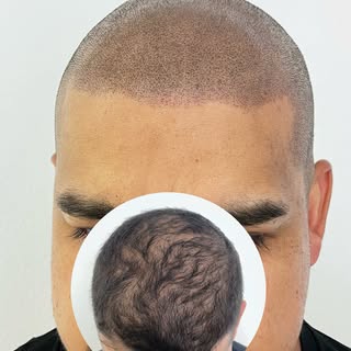 This client had noticeable thinning. After buzzing it down and adding SMP, we followed his natural h