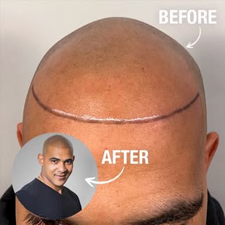 From no hairline… to a whole new look.
Subtle. Natural. Confidence restored.

#scalpmicropigmentatio