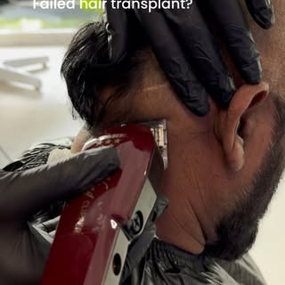 Scalp Micropigmentation is a cosmetic tattoo that creates the illusion of tiny follicles replicating