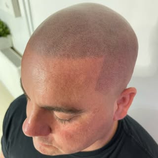 Hairline Reclaimed. Confidence Activated.

Swipe ⬅️ to see the power of Scalp Micropigmentation.
No 