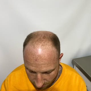 Restore Your Hair Instantly! Scalp Micropigmentation to Fill Out Hairlines, Shaved Styles, and Cover